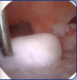 Arthroscopic Elbow Surgery