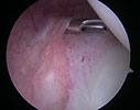 posterior capsule is inflamed, stiff, and thickened