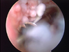 Arthroscopic Arthrofibrosis Release of a patient with PVNS
