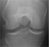 Knee Dislocation