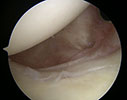 posterior capsule appeared thickened and stiff