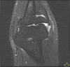 Common Extensor Origin Debridement