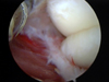 Arthroscopic Elbow Arthrofibrosis Release