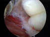 Arthroscopic Elbow Arthrofibrosis Release