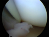 Arthroscopic Elbow Arthrofibrosis Release