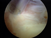 Arthroscopic Elbow Arthrofibrosis Release