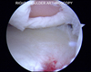 Osteochodral defect of humeral head with clearly defined boarders.