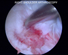 Micro fracturing of the glenoid lesion.