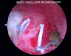 Labral repair was completed after micro fracture to help alleviate the patient's shoulder instability.