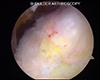 Shoulder Arthroscopy