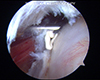 Shoulder Arthroscopy