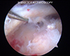 Shoulder Arthroscopy