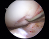 This picture demonstrates the process of micro fracturing where picks are used to disrupt the bone in areas of cartilage injury. By penetrating through the poorly vasculairzed harder outer layer of bone, the picks reach the softer inner layer of bone which bleeds more readily allowing cells to reach the outer surface and attempting to stimulate new cartilage growth.