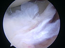 shoulder arthroscopy, his posterior labrum was frayed