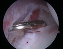 posterior capsule is released with the use of an arthroscopic scissors