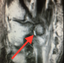 Hook of the Hamate Fracture