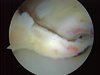 Arthroscopic Arthrofibrosis Release of a Total Knee Replacement