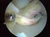 Arthroscopic Arthrofibrosis Release of a Total Knee Replacement
