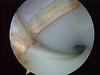 Arthroscopic Arthrofibrosis Release of a Total Knee Replacement