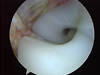 Arthroscopic Arthrofibrosis Release of a Total Knee Replacement