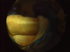 Arthroscopic Arthrofibrosis Release of a Total Knee Replacement