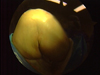 Arthroscopic Arthrofibrosis Release of a Total Knee Replacement