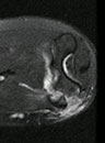 bony fragment contains the attachment of the common flexor origin