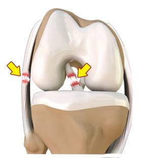   Multi-Ligament Knee Injuries  