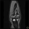 OCD Lesion with Micro Fracture