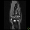 OCD Lesion with Micro Fracture