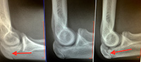 Olecranon Stress Fracture