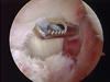 Arthroscopic Arthrofibrosis Release of a patient with PVNS