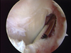 Arthroscopic Arthrofibrosis Release of a patient with PVNS