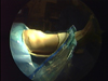 Arthroscopic Arthrofibrosis Release of a patient with PVNS
