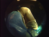 Arthroscopic Arthrofibrosis Release of a patient with PVNS