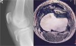 Tibial Tubercle Avulsion Fracture