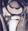 Tibial Tubercle Avulsion Fracture