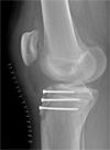 Tibial Tubercle Avulsion Fracture