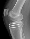 Tibial Tubercle Avulsion Fracture