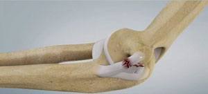 Ulnar Collateral Ligament (UCL) Reconstruction