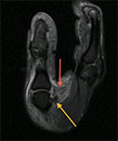 yellow arrow denotes the torn UCL