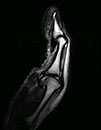 ligamentous instability at the MCP joint with volar subluxation