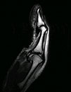 ligamentous instability at the MCP joint with volar subluxation