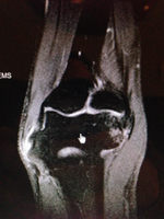 Ulnar Nerve Transposition